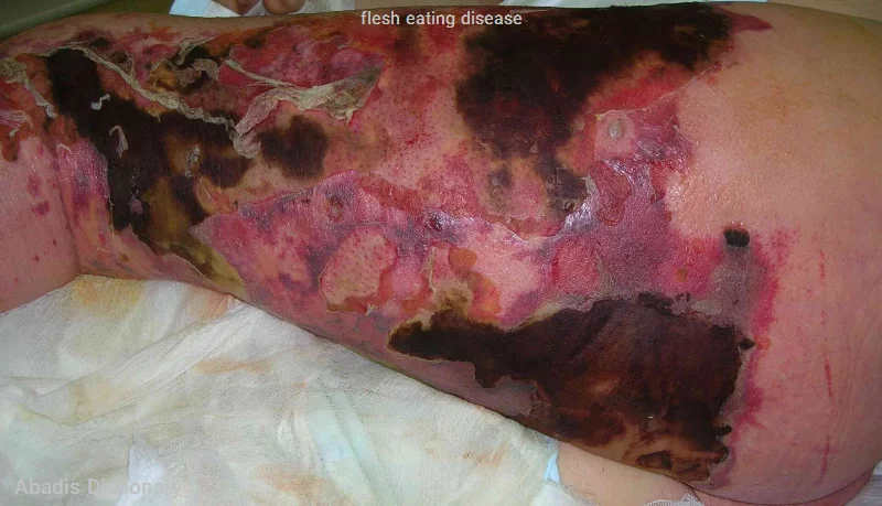 flesh eating disease